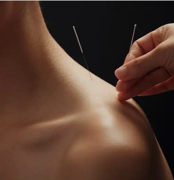 Managing Chemotherapy-Induced Peripheral Neuropathy (CIPN) with Acupuncture and Chinese Herbal Medicine