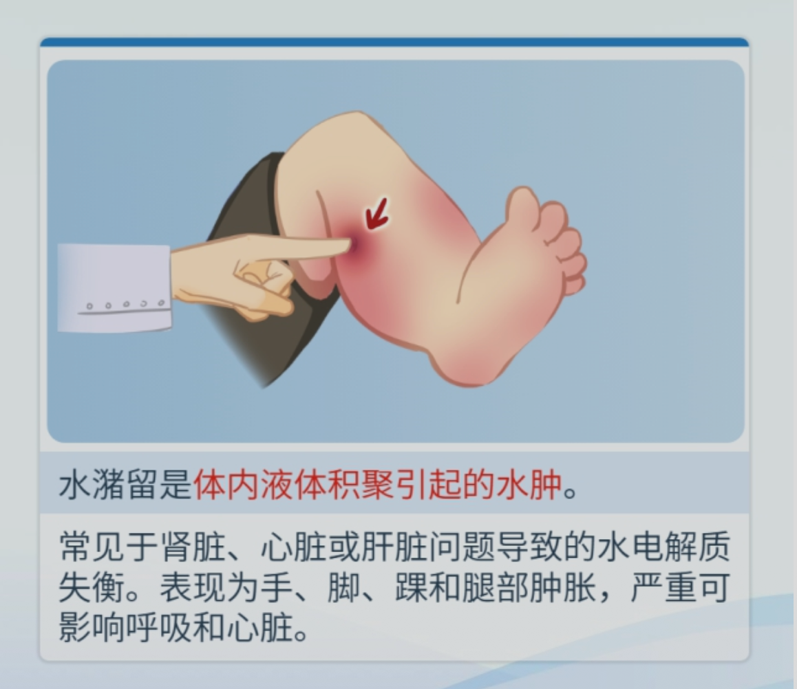 Clinical Therapy for Cancer Related Fluid Retention and Lymphatic Edema